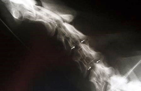 Cervical Vertebral Malformation figure 4
