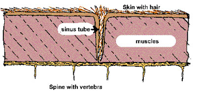 Dermoid Fig 1