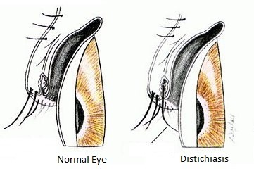Distichiasis figure 1