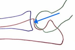 Elbow Dysplasia (FMCP) figure 3