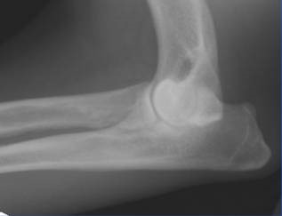 Elbow Dysplasia (FMCP) figure 4