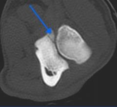 Elbow Dysplasia (FMCP) figure 5