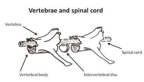 Hemivertebrae figure 2