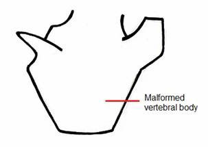 Hemivertebrae figure 3