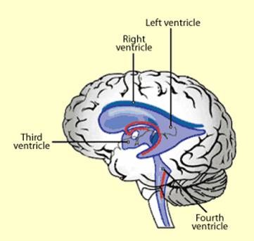 Hydrocephalus figure 1