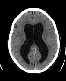 Hydrocephalus figure 2