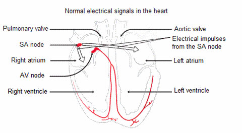 Hypertrophic Cardiomyopathy figure 2