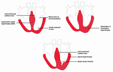 Hypertrophic Cardiomyopathy figure 3
