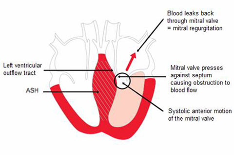 Hypertrophic Cardiomyopathy figure 4
