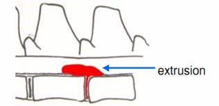 Intervertebral Disc Disease figure 3b