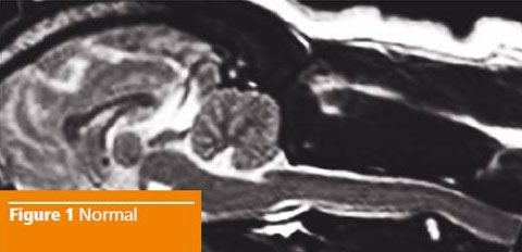 Syringomyelia Fig1