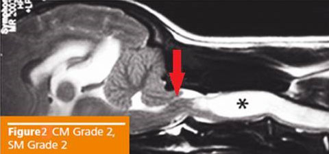 Syringomyelia Fig2