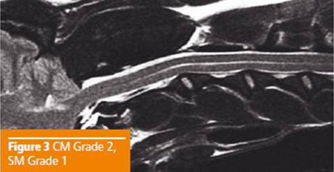 Syringomyelia Fig3
